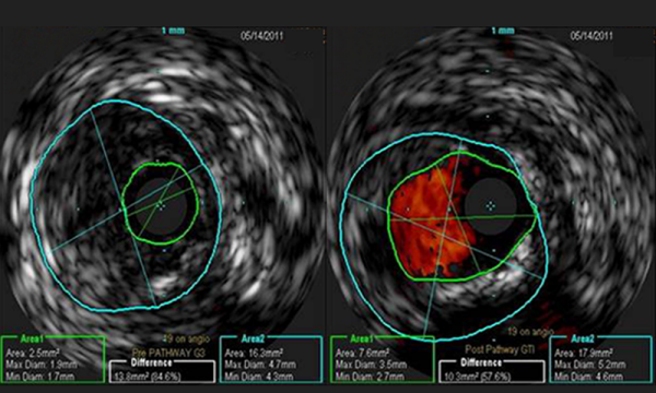 Jetstream™ Atherectomy System - Resource Center - Boston Scientific