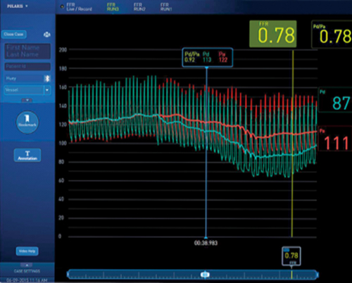 PCI Clinical Data - FFR-Guided Procedures vs. Angio - Boston Scientific