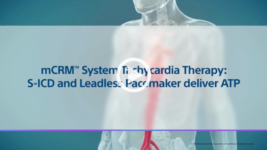 mCRM™ System Tachycardia Therapy: S-ICD and Leadless Pacemaker deliver ATP