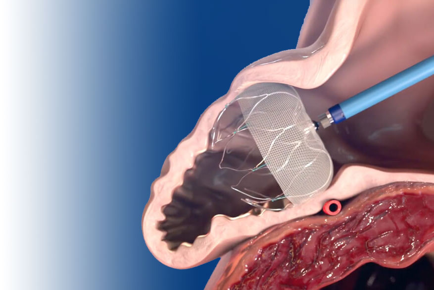 Left Atrial Appendage Closure (LAAC) Therapy – Structural Heart