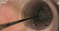 endoscopic-footage-balloon-endoscopy-240x128.jpg