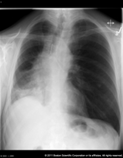 Stents: Pulmonary Images - Boston Scientific