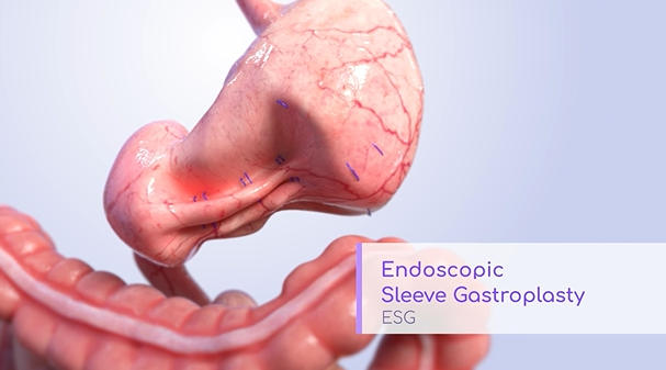 Endoscopic Sleeve Gastroplasty Animation