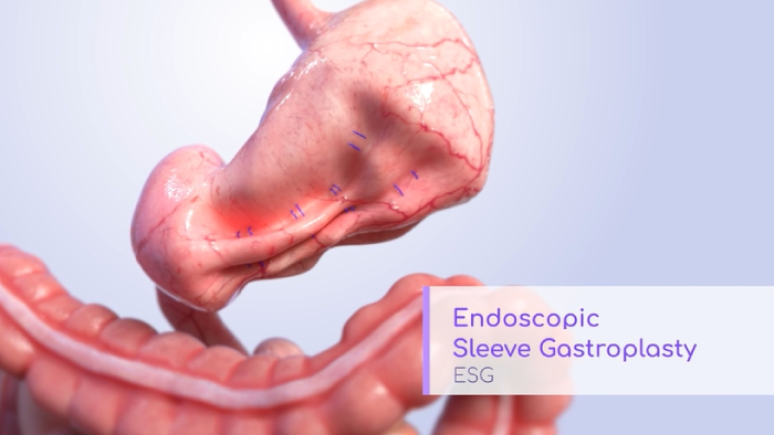 Endoscopic Sleeve Gastroplasty Animation