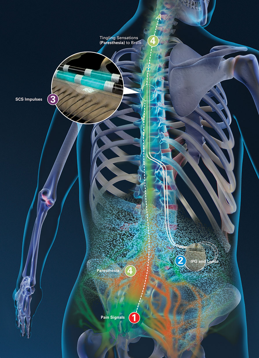 abbott burst system spinal cord stimulator