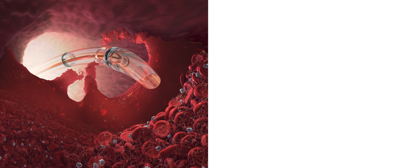 Learn more about AngioJet™ ZelanteDVT™ Thrombectomy Catheter