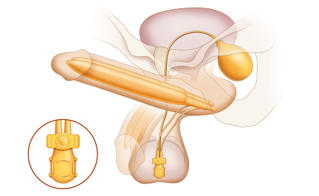 AMS 700™ Inflatable Penile Prosthesis with TENACIO™ Pump - Illustration 1