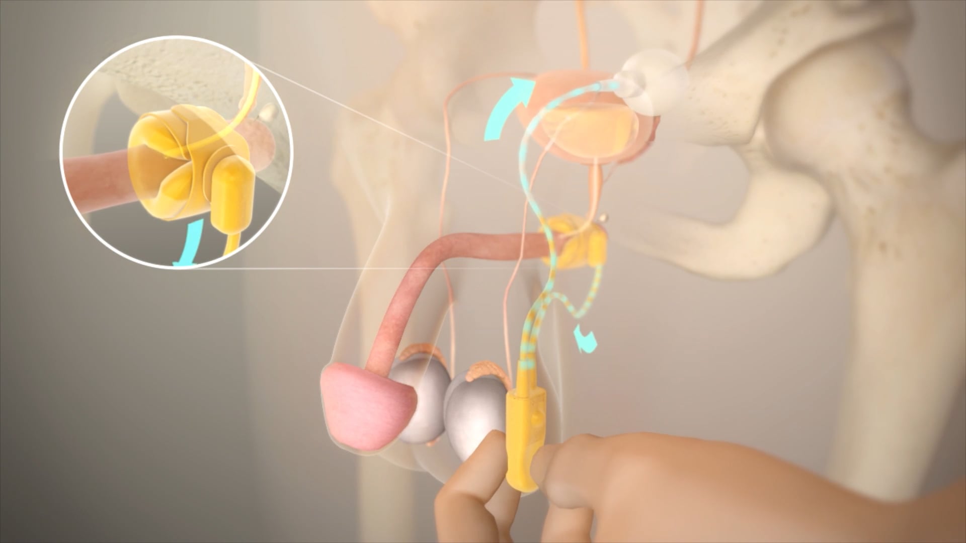 AMS 800™ Artificial Urinary Control System Animation.