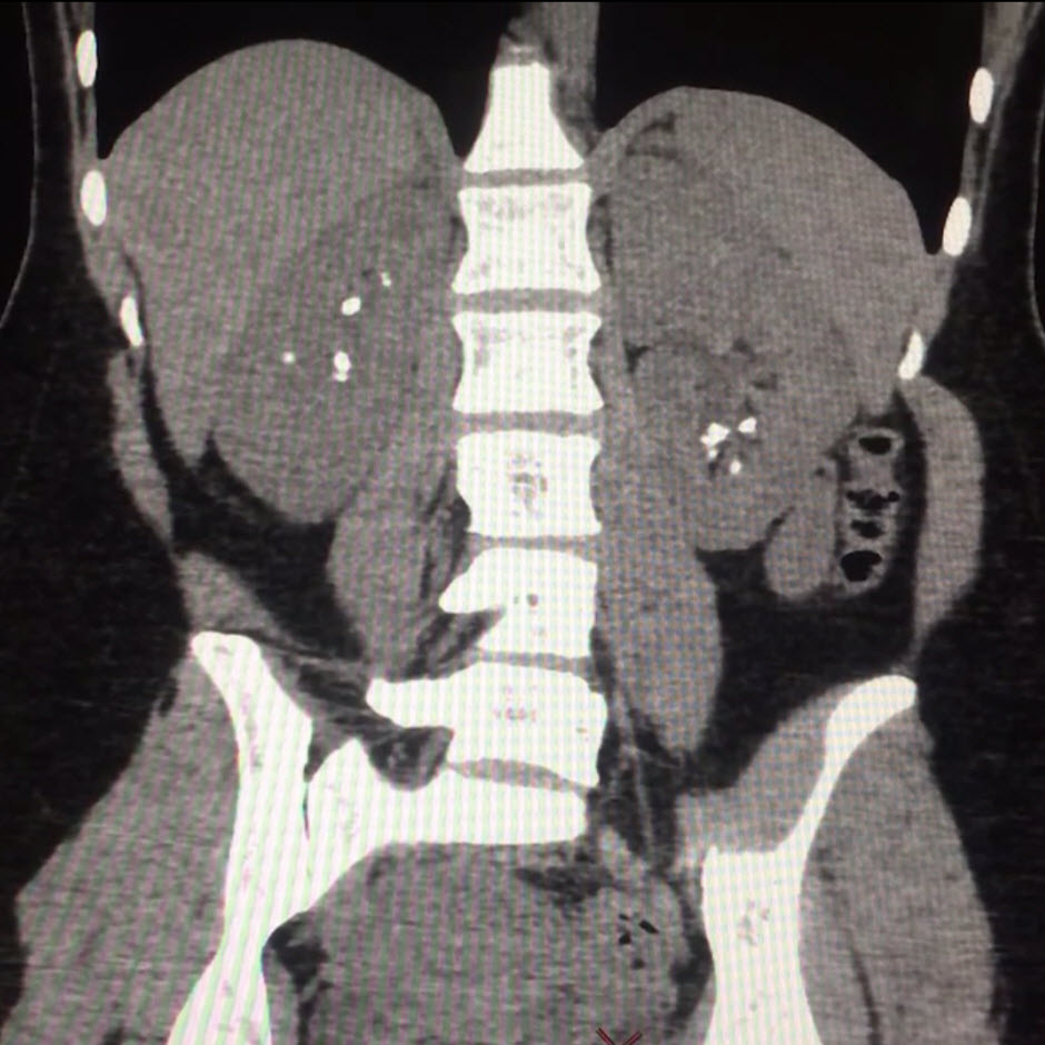 Ureteroscopy Case Study video.