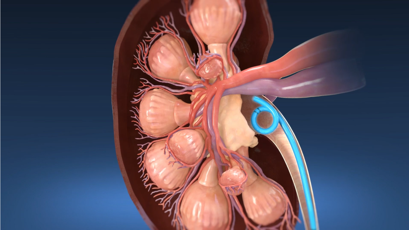 Informational video about ureteral stents.