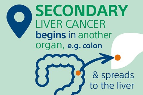 Secondary liver cancer