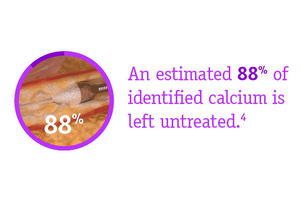 An estimated 88% of identified calcium is left untreated.