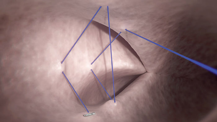 representing suturing procedure