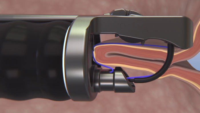 OverStitch™ NXT Endoscopic Suturing System - Boston Scientific