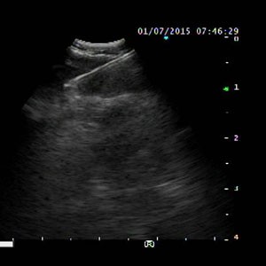 Highly Visible Echogenic Pattern