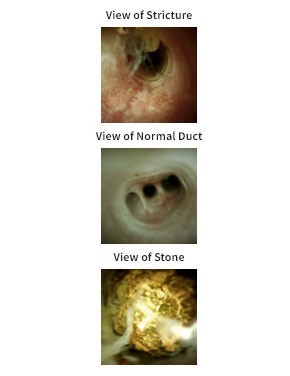 SpyGlass DS System Intraductal Images