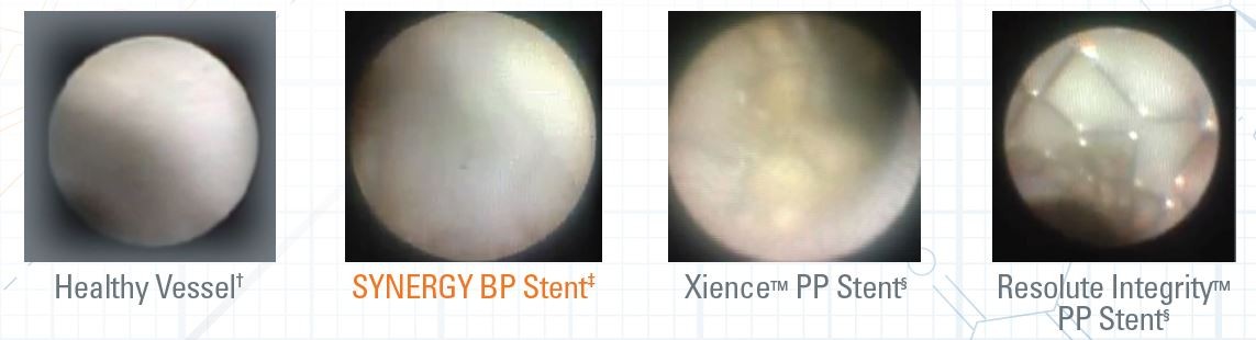 Angioscopy demonstrates differentiated and improved healing with SYNERGY BP Stent.
