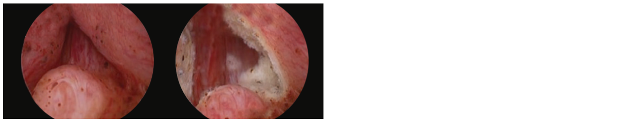 2 scope images. Identifying anatomical landmarks (image shows left ureteral orifice).