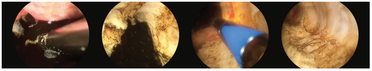 4 scope images. Which are illustrating how to debulk the prostate.