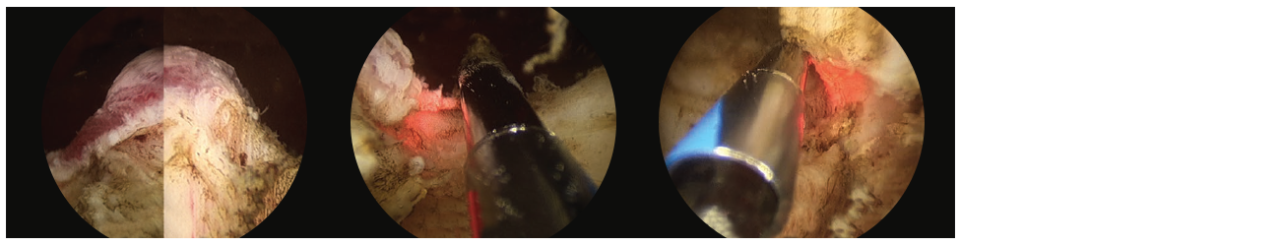 3 scope images. Identifying verumontanum.