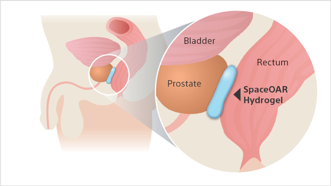 Improving Prostate Cancer Treatment with Hydrogel Spacers