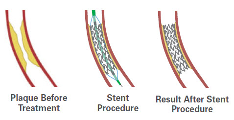 stent in the heart