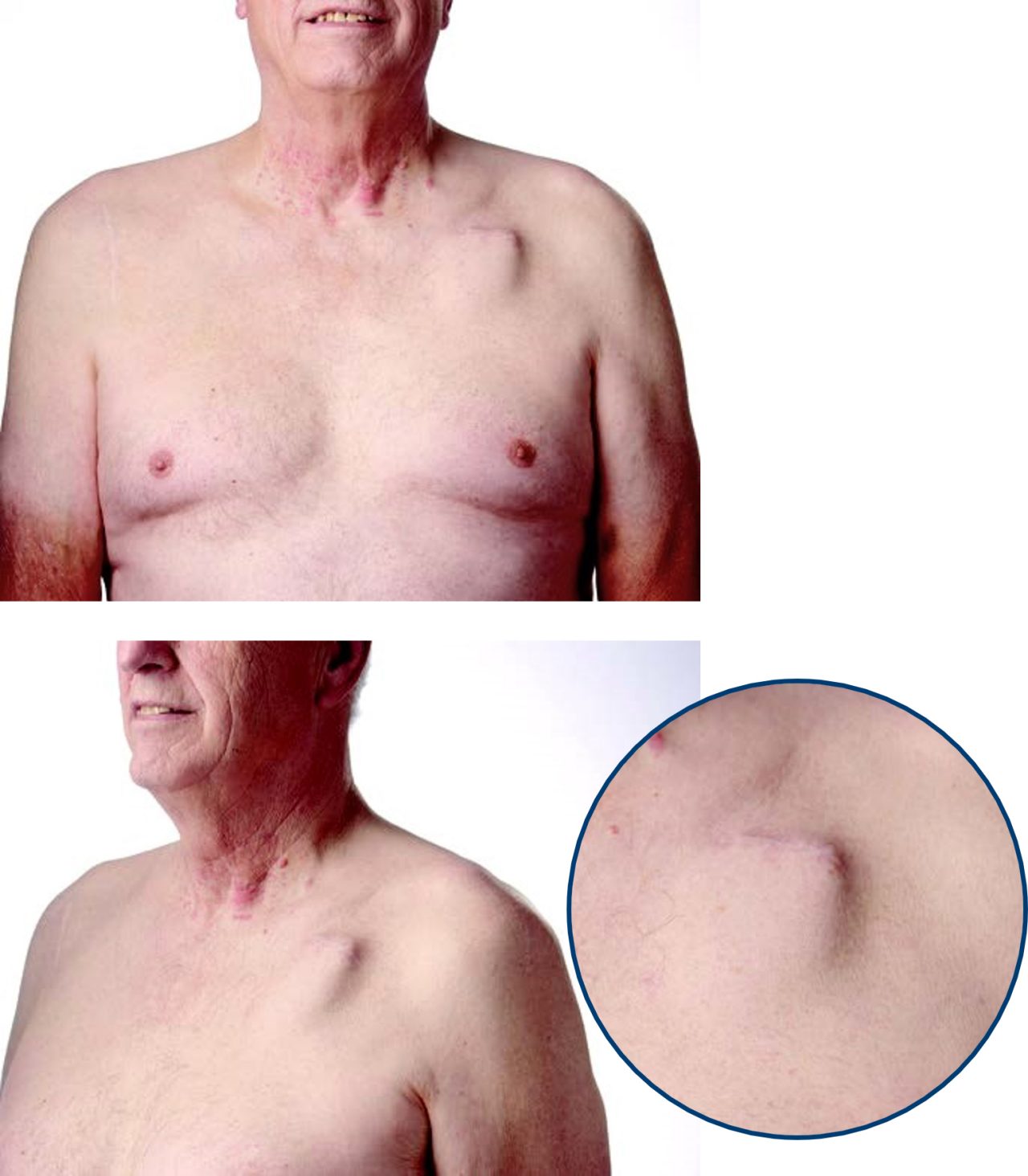 Front and side view of male patient with DYNAGEN EL ICD.