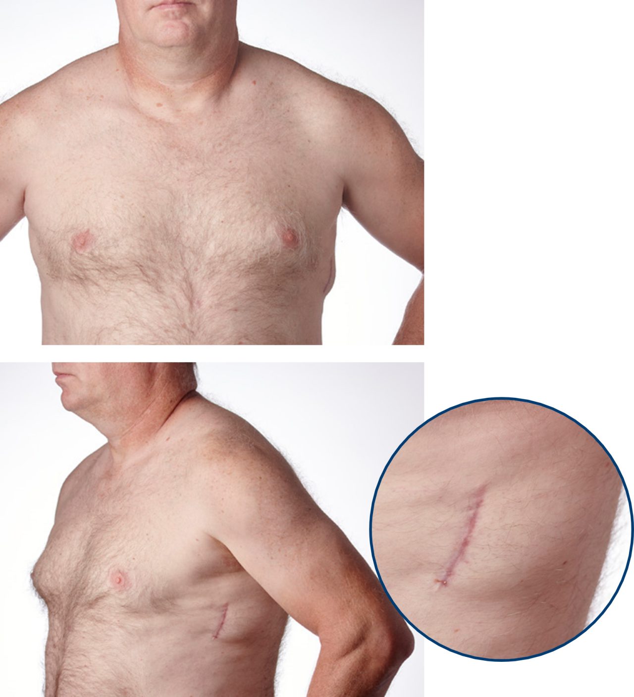 Front and side view of male patient with EMBLEM S-ICD.