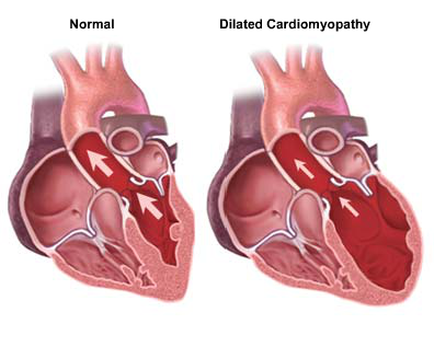 Dilated Cardiomyopathy - Patient Information - Boston Scientific