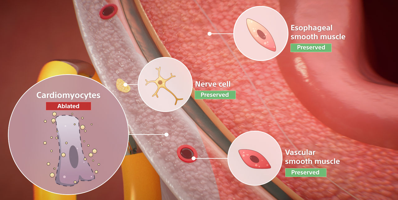 Farapulse system overview