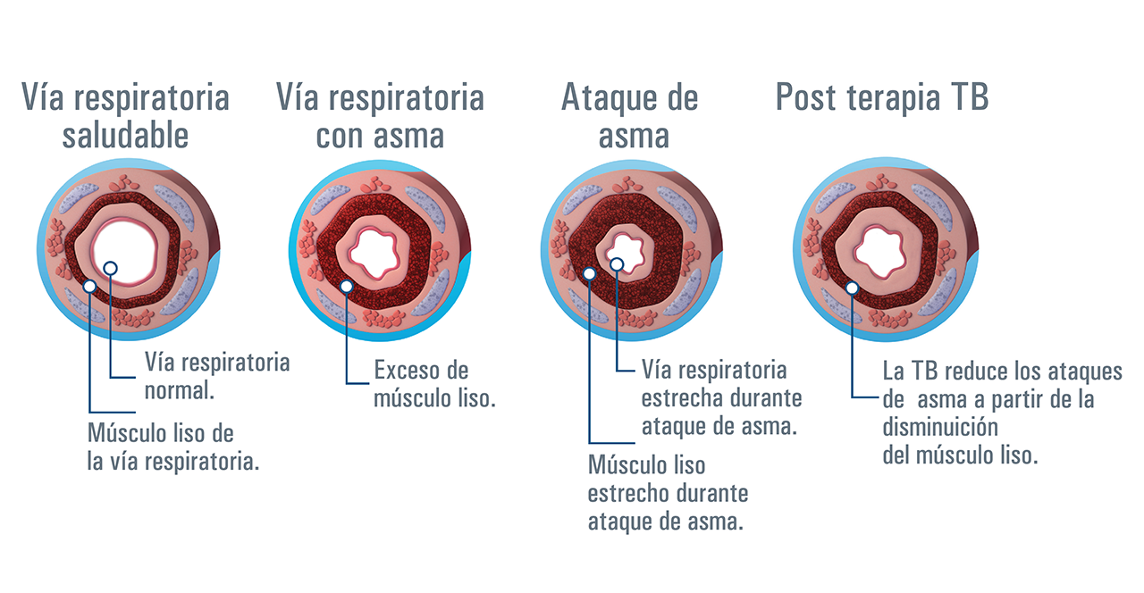 El asma y las vías respiratorias