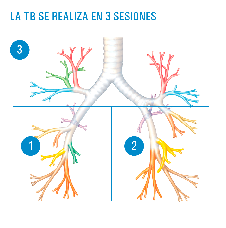 termoplastia bronquial