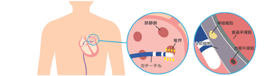 バルーンアブレーション治療